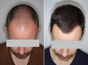 antes-despues-trasplante-pelo-tecnica-fue-rasurado-total